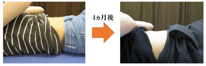 腹直筋お喜びの声　金町　整体