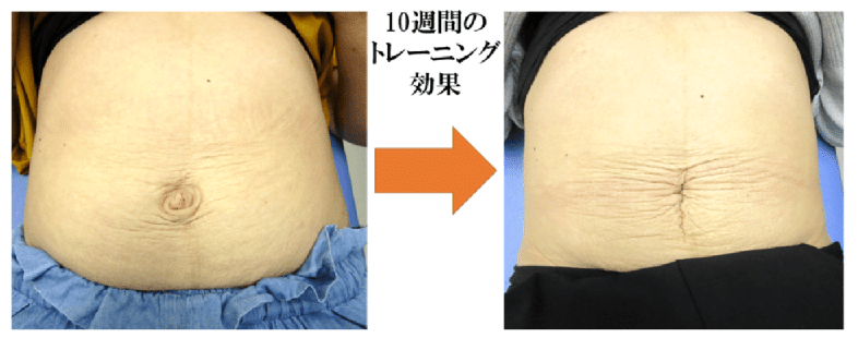 腹直筋お喜びの声　金町　整体
