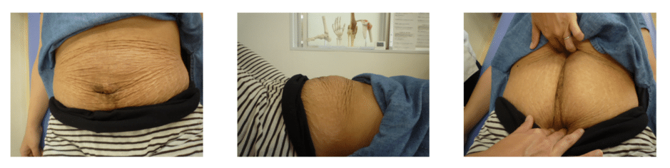 【葛飾区金町のやぎはし整体院】腹直筋離開の治し方を実例をもとに詳しく紹介