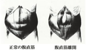 【葛飾区金町のやぎはし整体院】腹直筋離開の治し方を実例をもとに詳しく紹介