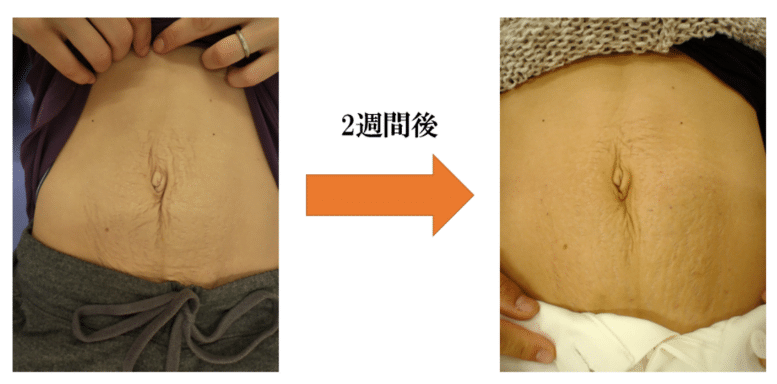 【葛飾区金町のやぎはし整体院】腹直筋離開の治し方を実例をもとに詳しく紹介