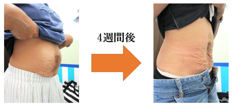 腹直筋お喜びの声　金町　整体