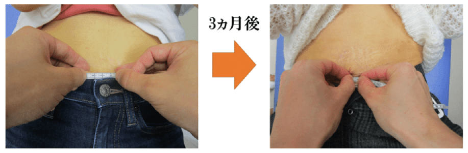 腹直筋お喜びの声　金町　整体
