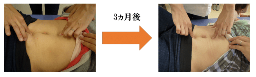 【葛飾区金町のやぎはし整体院】腹直筋離開の治し方を実例をもとに詳しく紹介