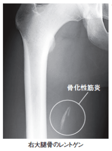 【葛飾区金町のやぎはし整体院】骨化性筋炎（異所性骨化）