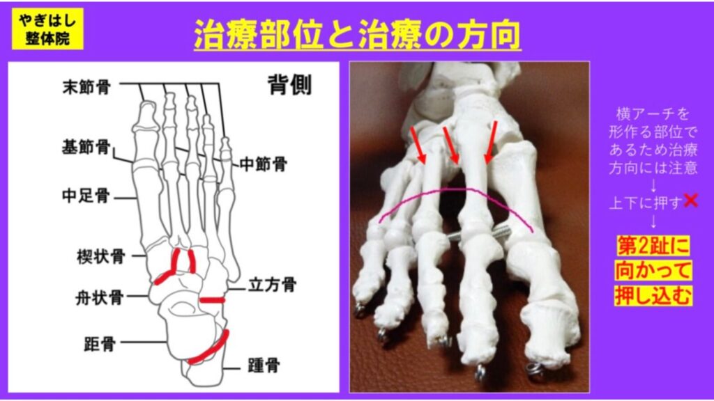 坐骨神経痛に対する関節治療２