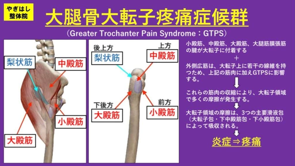 大腿骨大天使疼痛症候群
