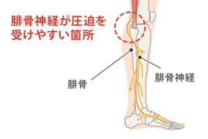 【葛飾区金町のやぎはし整体院】金町で腓骨神経麻痺を改善できるオススメのやぎはし整体院