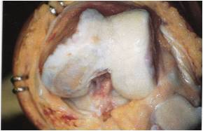 膝軟骨のすり減り