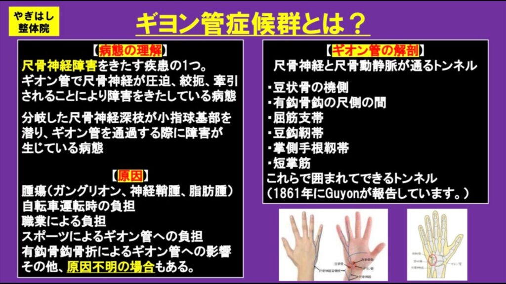 ギヨン管症候群