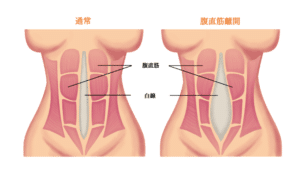 【葛飾区金町のやぎはし整体院】産後・腹直筋離開オンライン診療