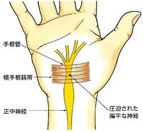 【葛飾区金町のやぎはし整体院】金町で『手根管症候群』専門の整体