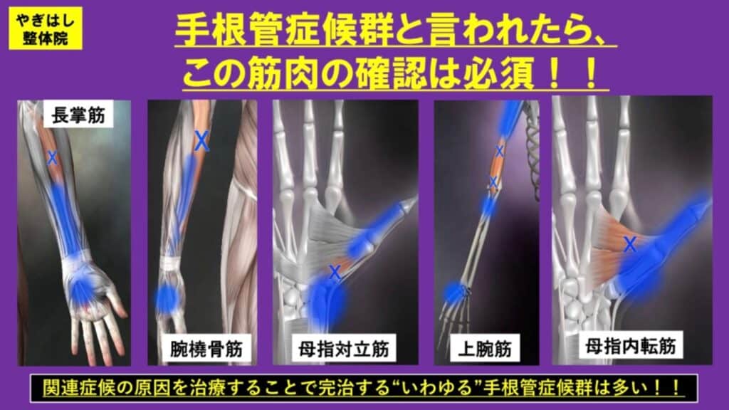 手根管症候群の治療３