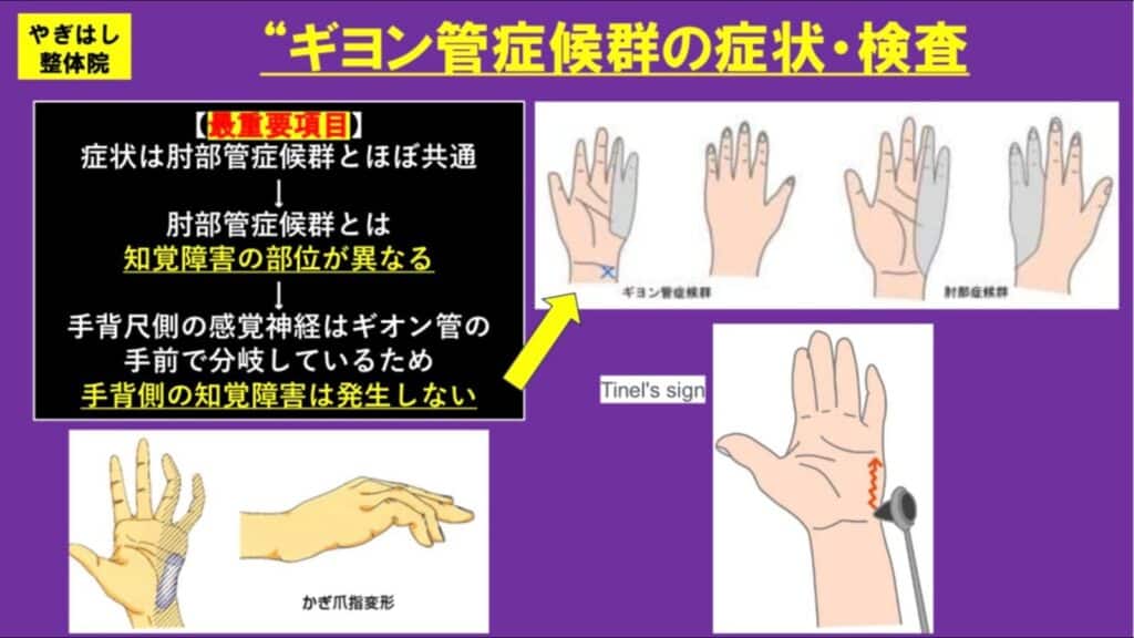ギヨン管症候群２