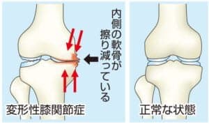 【葛飾区金町のやぎはし整体院】金町で「変形性膝関節症」専門の整体