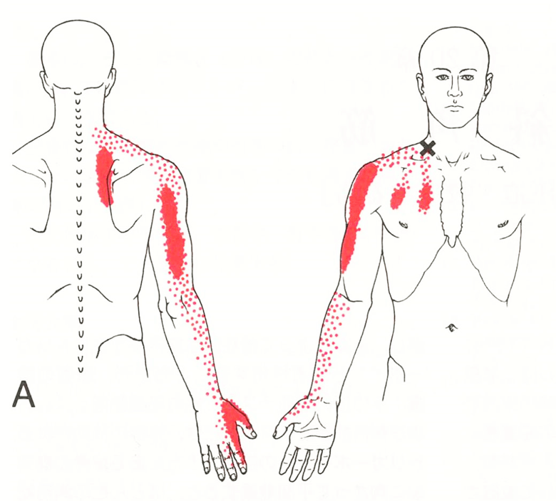 トリガーポイント