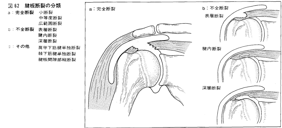腱板断裂の分類