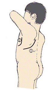 胸腔鏡併用手術