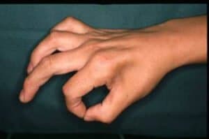 【葛飾区金町のやぎはし整体院】金町で尺骨神経麻痺を根本改善する整体