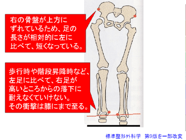 脚長差がひざ痛の原因のひとつ