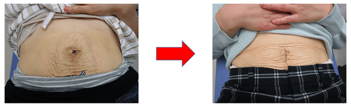 【葛飾区金町のやぎはし整体院】産後・腹直筋離開オンライン診療