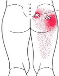 トリガーポイント