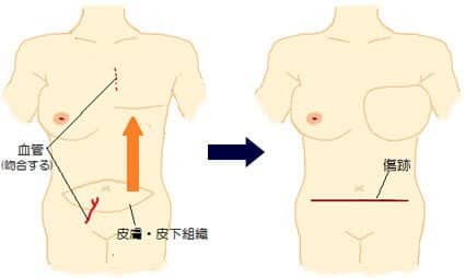自家組織を使った乳房再建術