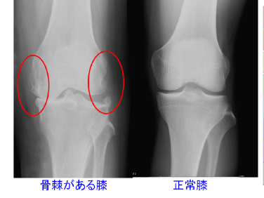 レントゲン写真