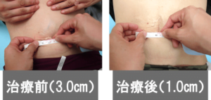 【葛飾区金町のやぎはし整体院】腹直筋離開 治療前後の比較