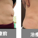 【葛飾区金町のやぎはし整体院】腹直筋離開の無理のない治し方を紹介!