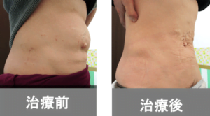 【葛飾区金町のやぎはし整体院】腹直筋離開の無理のない治し方を紹介！