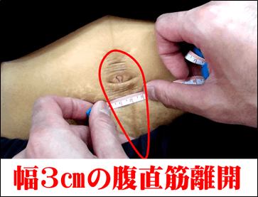 腹直筋離開