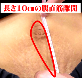 腹直筋離開