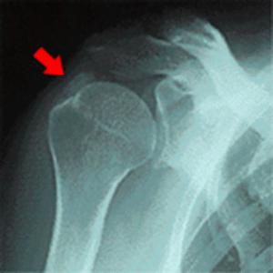 【葛飾区金町のやぎはし整体院】金町で「石灰沈着性腱板炎」専門の整体