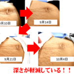 【葛飾区金町のやぎはし整体院】腹直筋離開が治った時の写真を公開中!