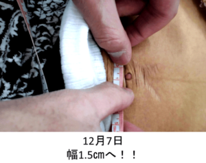 【葛飾区金町のやぎはし整体院】知らなきゃ損する腹直筋離開の改善に必要なこととは？