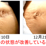 【葛飾区金町のやぎはし整体院】腹直筋離開でも背骨や肋骨・股関節を治療することが大事！