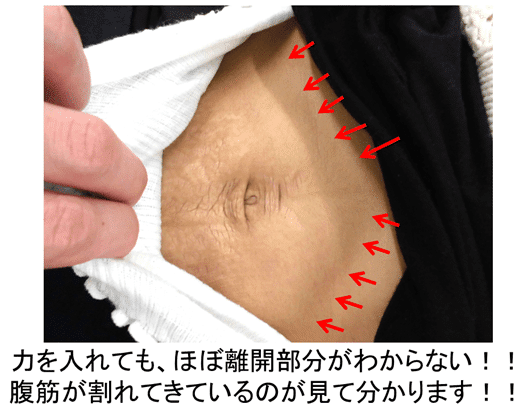 腹直筋離開