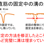 【葛飾区金町のやぎはし整体院】再発しない腹直筋離開のトレーニング方法