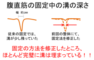【葛飾区金町のやぎはし整体院】再発しない腹直筋離開のトレーニング方法