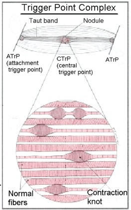 トリガーポイント