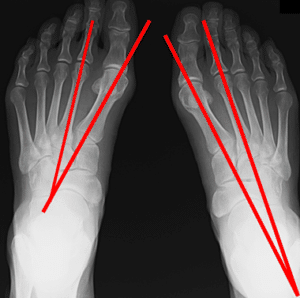 【葛飾区金町のやぎはし整体院】ひざの整体　母趾を整える