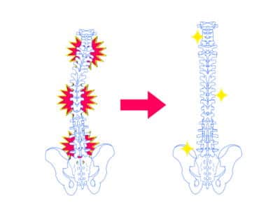 背骨のゆがみ