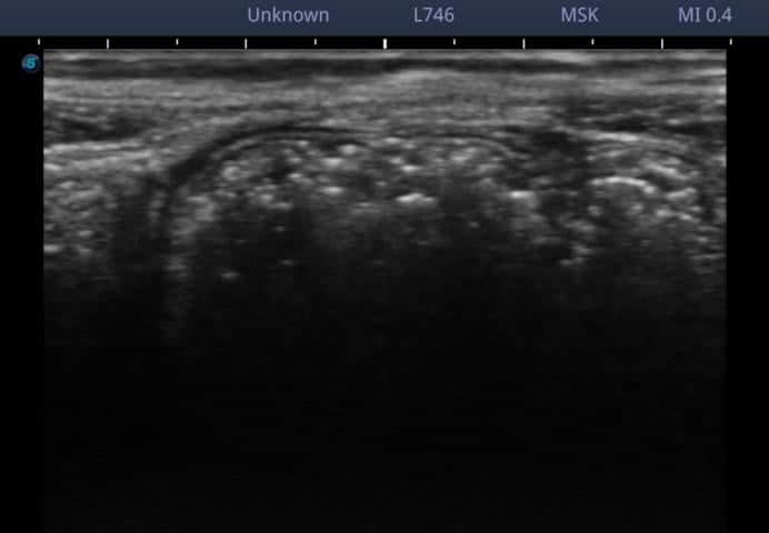腹直筋離開のエコー写真