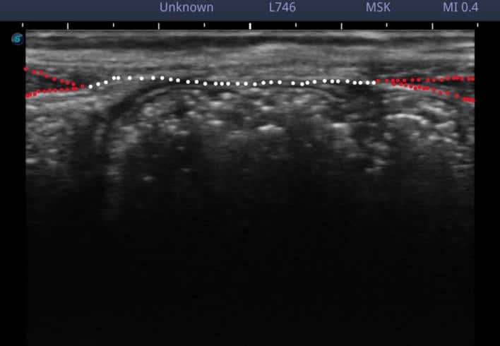 腹直筋離開のエコー写真