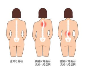 【葛飾区金町のやぎはし整体院】金町で「側弯症」専門の整体