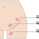 【葛飾区金町のやぎはし整体院】腹直筋離開と鼠径部の痛みは関係ある？