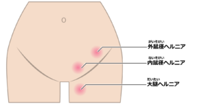 【葛飾区金町のやぎはし整体院】腹直筋離開と鼠径部の痛みは関係ある？