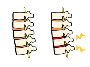 【葛飾区金町のやぎはし整体院】頸椎症性神経根症