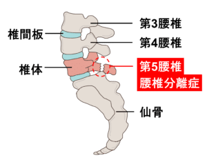 【葛飾区金町のやぎはし整体院】金町で「腰椎分離症」専門の治療・整体